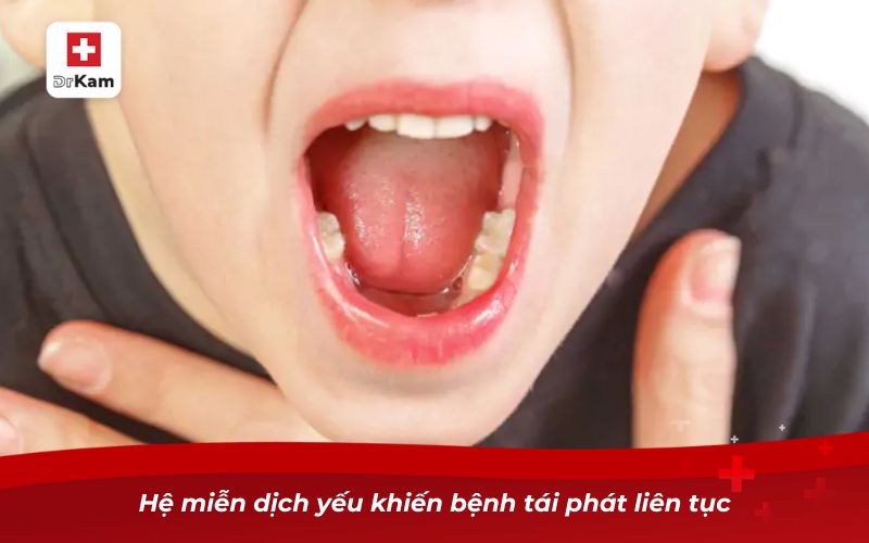 Viêm họng liên cầu ở trẻ em: Dấu hiệu, nguyên nhân và cách điều trị 9 Có nhiều nguyên nhân khiến trẻ mắc viêm họng liên cầu