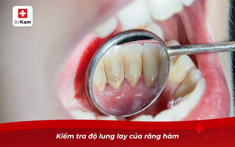 Cách nhổ răng hàm bị sâu tại nhà đơn giản và an toàn 10 Kiểm tra độ lung lay của răng hàm