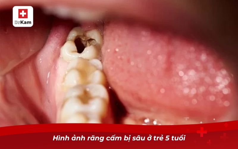 Hình ảnh răng cấm bị sâu ở trẻ 5 tuổi