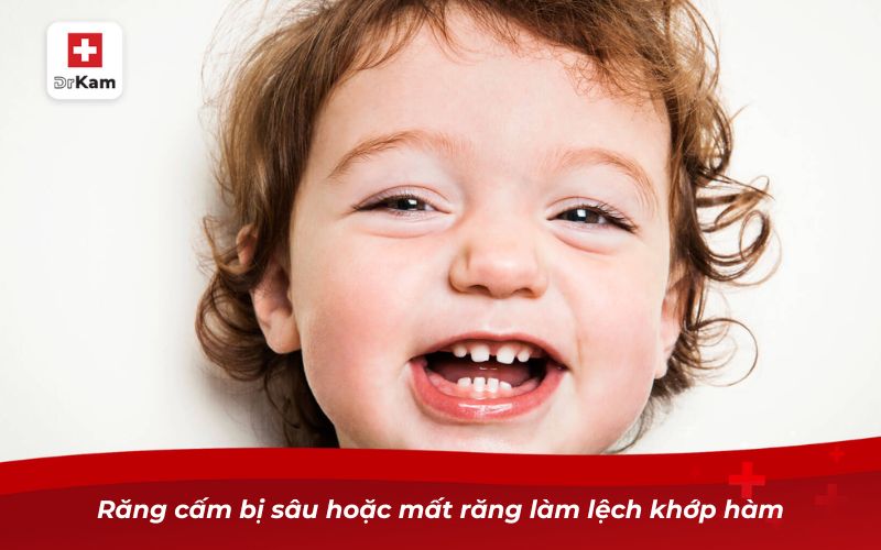 Răng cấm bị sâu hoặc mất răng làm lệch khớp hàm