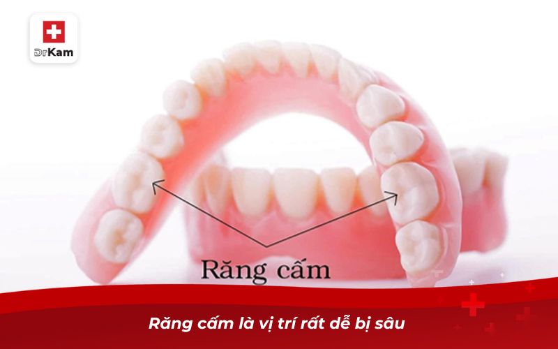 Răng cấm là vị trí rất dễ bị sâu 