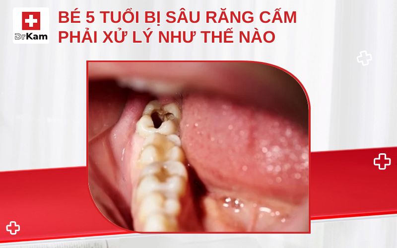 be 5 tuoi bi sau rang cam thumbnail