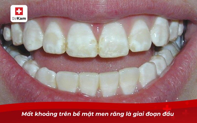 Mất khoảng trên bề mặt men răng là giai đoạn đầu 