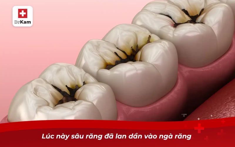 Lúc này sâu răng đã lan dần vào ngà răng 
