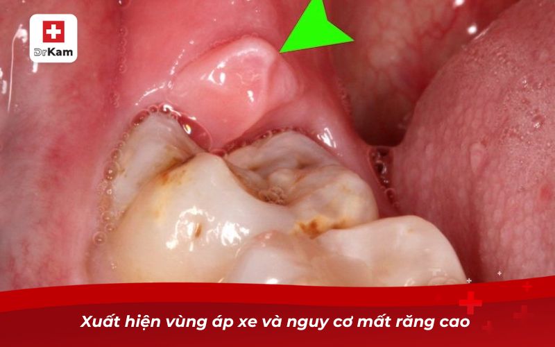 Xuất hiện vùng áp xe và nguy cơ mất răng cao 