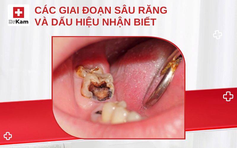 cac giai doan sau rang thumbnail