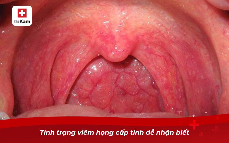 Các loại viêm họng: Nguyên nhân, triệu chứng và cách điều trị 17 Tình trạng viêm họng cấp tính dễ nhận biết