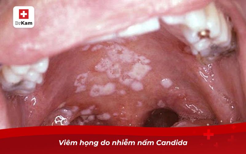 Các loại viêm họng: Nguyên nhân, triệu chứng và cách điều trị 28 Viêm họng do nhiễm nấm Candida