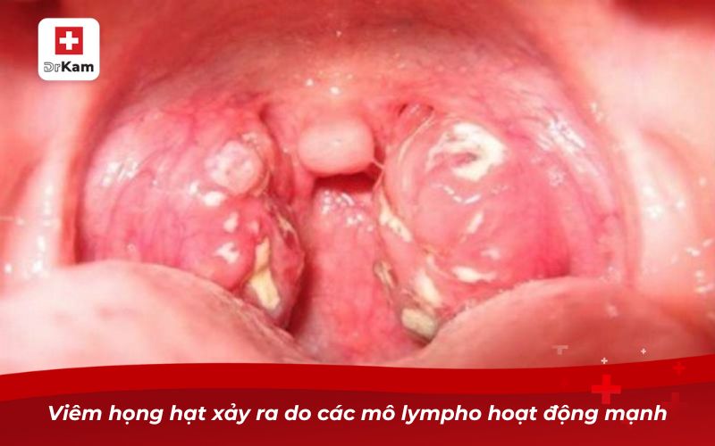 Các loại viêm họng: Nguyên nhân, triệu chứng và cách điều trị 21 Viêm họng hạt xảy ra do các mô lympho hoạt động mạnh