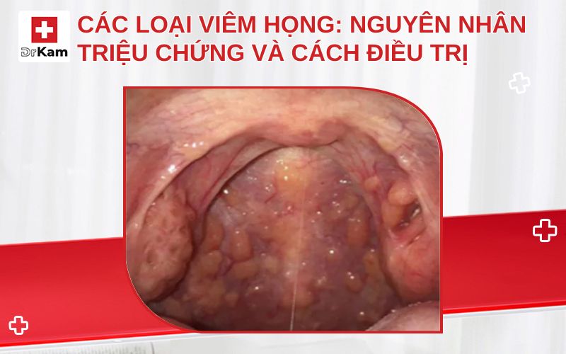 cac loai viem hong thumbnail 1