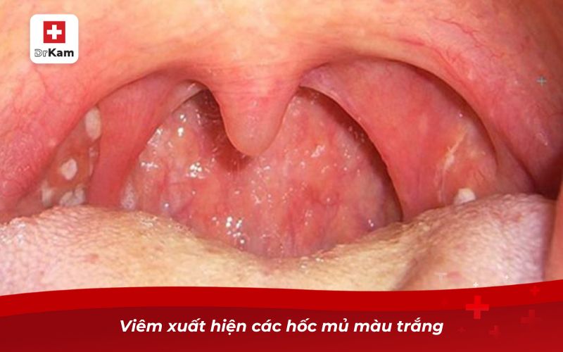 10 cách chữa viêm amidan hốc mủ tại nhà an toàn, hiệu quả 7 Viêm xuất hiện các hốc mủ màu trắng