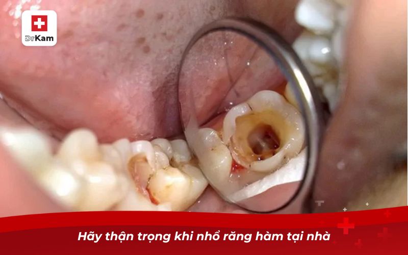 Cách nhổ răng hàm bị sâu tại nhà đơn giản và an toàn 8 Hãy thận trọng khi nhổ răng hàm tại nhà
