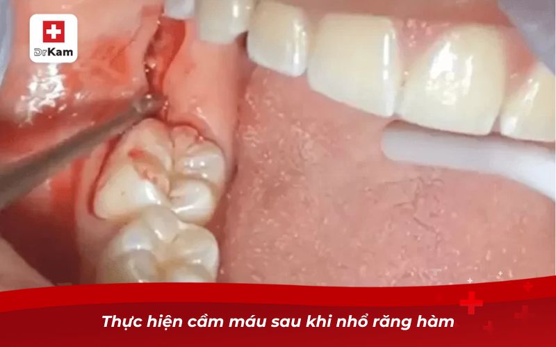 Cách nhổ răng hàm bị sâu tại nhà đơn giản và an toàn 11 cach nho rang ham bi sau tai nha 3 1