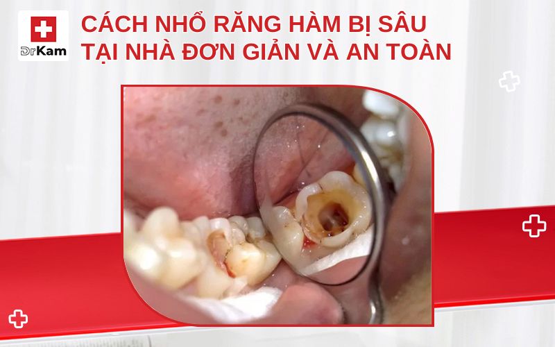 Thực hiện cầm máu sau khi nhổ răng hàm