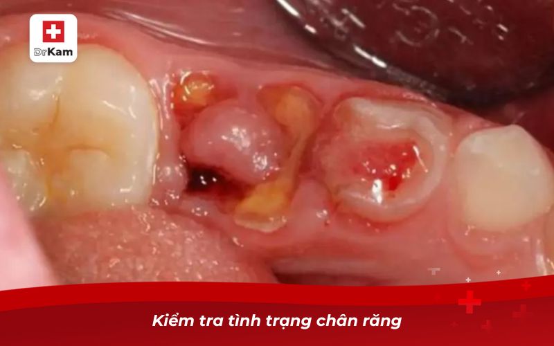 Cách nhổ răng sâu chỉ còn chân răng an toàn 7 Kiểm tra tình trạng chân răng