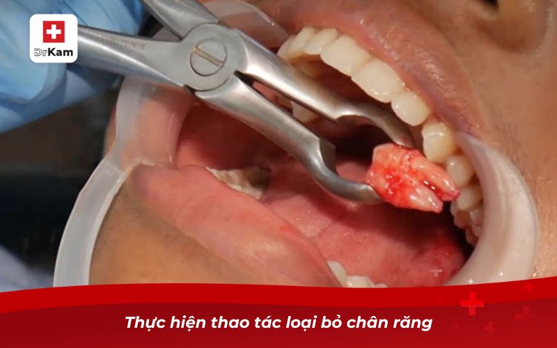 Cách nhổ răng sâu chỉ còn chân răng an toàn 8 Thực hiện thao tác loại bỏ chân răng