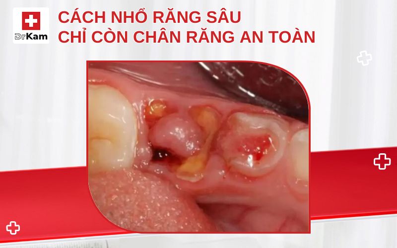cach nho rang sau chi con chan rang thumbnail