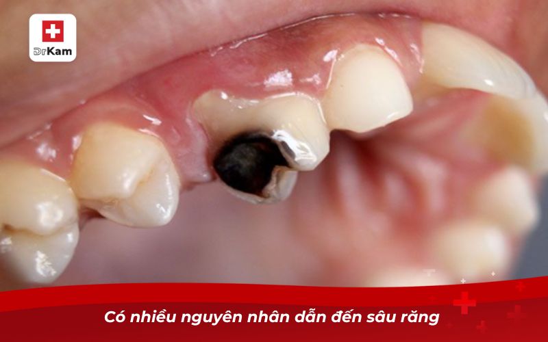 Cách trị sâu răng vĩnh viễn hiệu quả nhất 8 Có nhiều nguyên nhân dẫn đến sâu răng