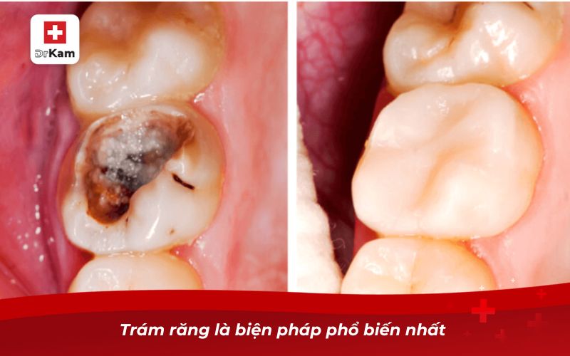 Cách trị sâu răng vĩnh viễn hiệu quả nhất 9 Trám răng là biện pháp phổ biến nhất