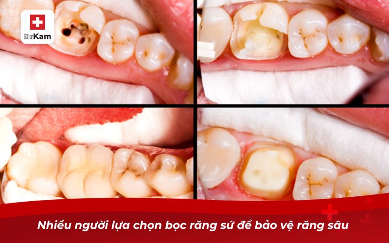 Cách trị sâu răng vĩnh viễn hiệu quả nhất 10 Nhiều người lựa chọn bọc răng sứ để bảo vệ răng sâu