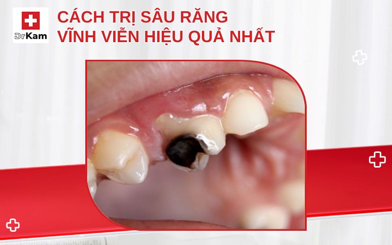 cach tri sau rang vinh vien thumbnail