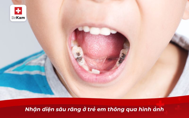 Hình ảnh sâu răng ở trẻ em: Dấu hiệu nhận biết và cảnh báo 6 Nhận diện sâu răng ở trẻ em thông qua hình ảnh