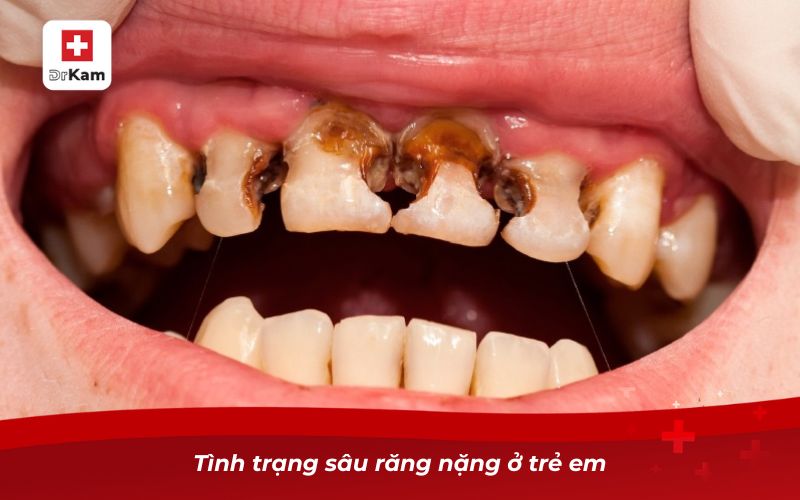 Hình ảnh sâu răng ở trẻ em: Dấu hiệu nhận biết và cảnh báo 7 Tình trạng sâu răng nặng ở trẻ em