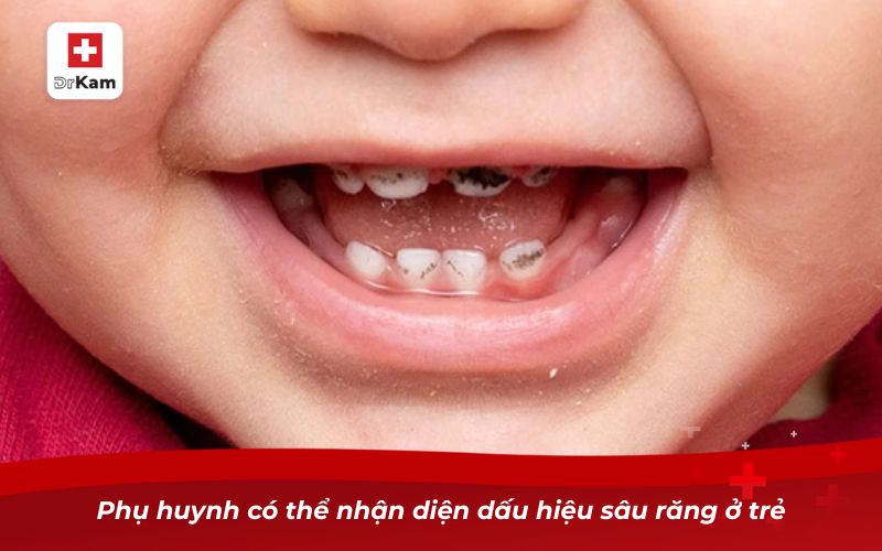 Hình ảnh sâu răng ở trẻ em: Dấu hiệu nhận biết và cảnh báo 8 Phụ huynh có thể nhận diện dấu hiệu sâu răng ở trẻ