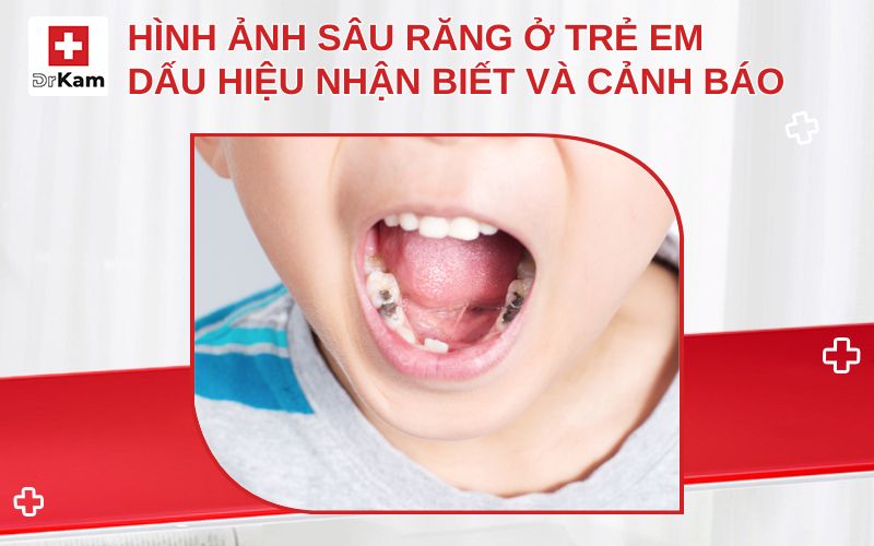 hinh anh sau rang o tre em thumbnail