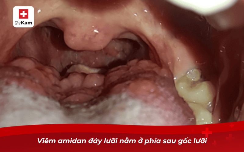 Hình ảnh viêm amidan đáy lưỡi và dấu hiệu nhận biết 8 Viêm amidan đáy lưỡi nằm ở phía sau gốc lưỡi