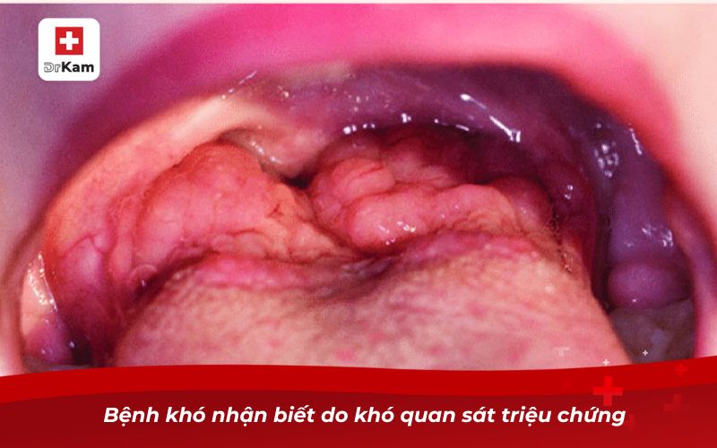 Hình ảnh viêm amidan đáy lưỡi và dấu hiệu nhận biết 9 Bệnh khó nhận biết do khó quan sát triệu chứng