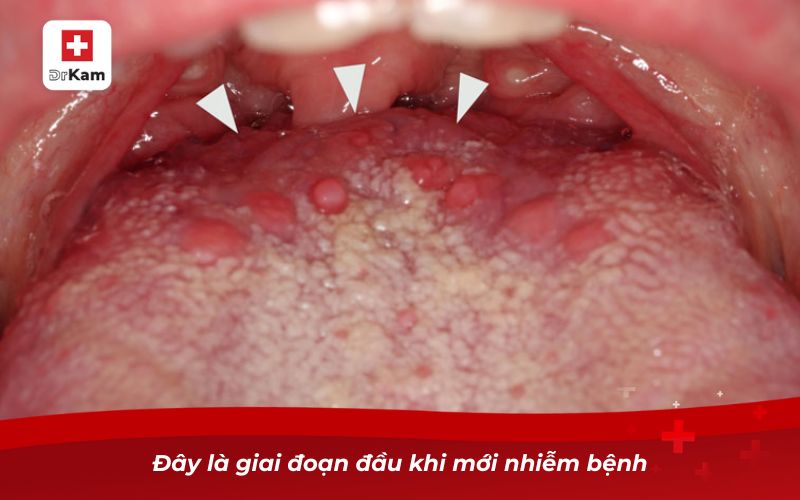 Hình ảnh viêm amidan đáy lưỡi và dấu hiệu nhận biết 10 Đây là giai đoạn đầu khi mới nhiễm bệnh