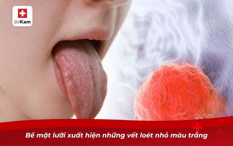 Hình ảnh viêm amidan đáy lưỡi và dấu hiệu nhận biết 11 Bề mặt lưỡi xuất hiện những vết loét nhỏ màu trắng
