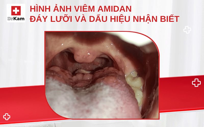hinh anh viem amidan day luoi thumbnail