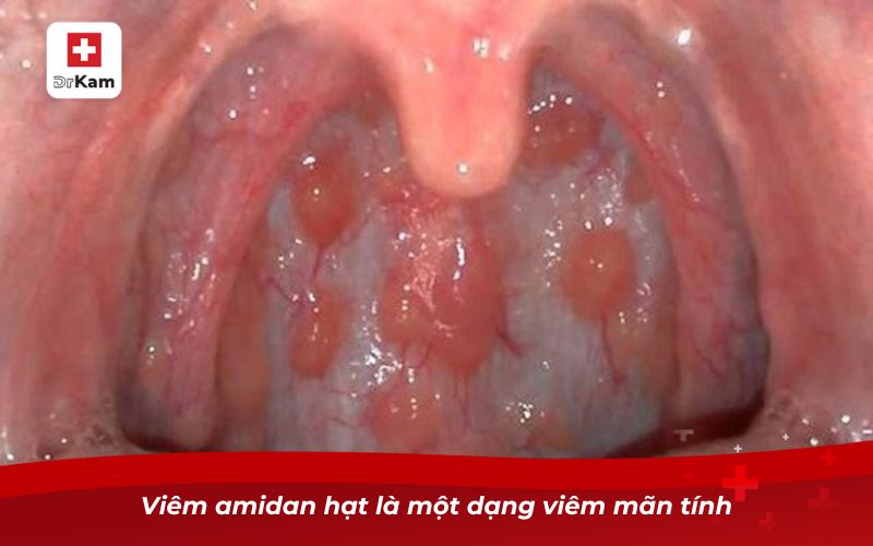 Hình ảnh viêm amidan hạt và cách nhận biết hiệu quả 6 Viêm amidan hạt là một dạng viêm mãn tính