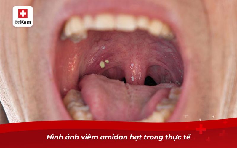 Hình ảnh viêm amidan hạt và cách nhận biết hiệu quả 7 Hình ảnh viêm amidan hạt trong thực tế