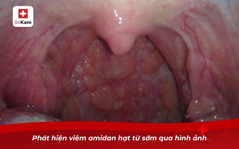 Hình ảnh viêm amidan hạt và cách nhận biết hiệu quả 8 Phát hiện viêm amidan hạt từ sớm qua hình ảnh