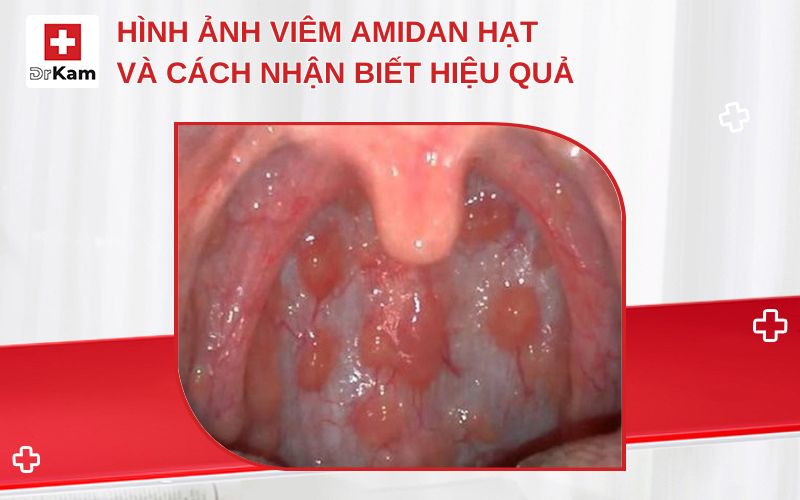 hinh anh viem amidan hat thumbnail
