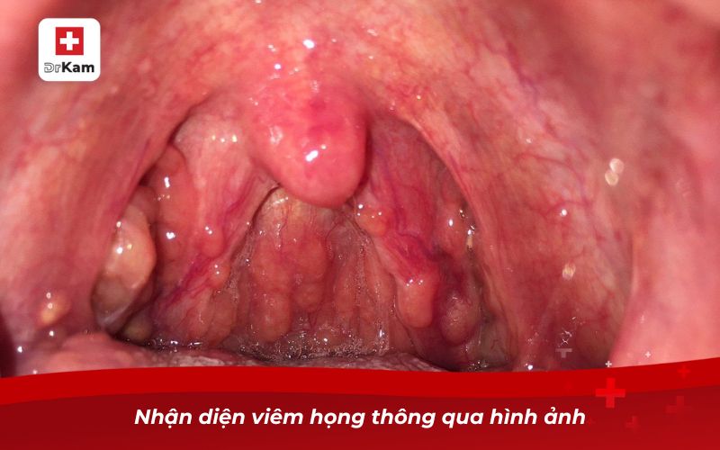 Cách nhận biết chính xác hình ảnh bị viêm họng bình thường 6 Nhận diện viêm họng thông qua hình ảnh