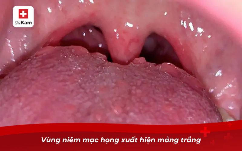 Cách nhận biết chính xác hình ảnh bị viêm họng bình thường 8 Vùng niêm mạc họng xuất hiện mảng trắng