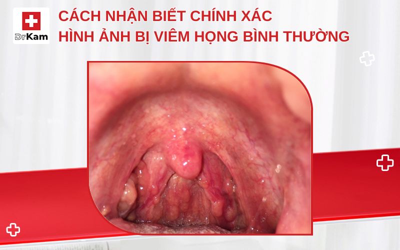 hinh anh viem hong binh thuong thumbnail