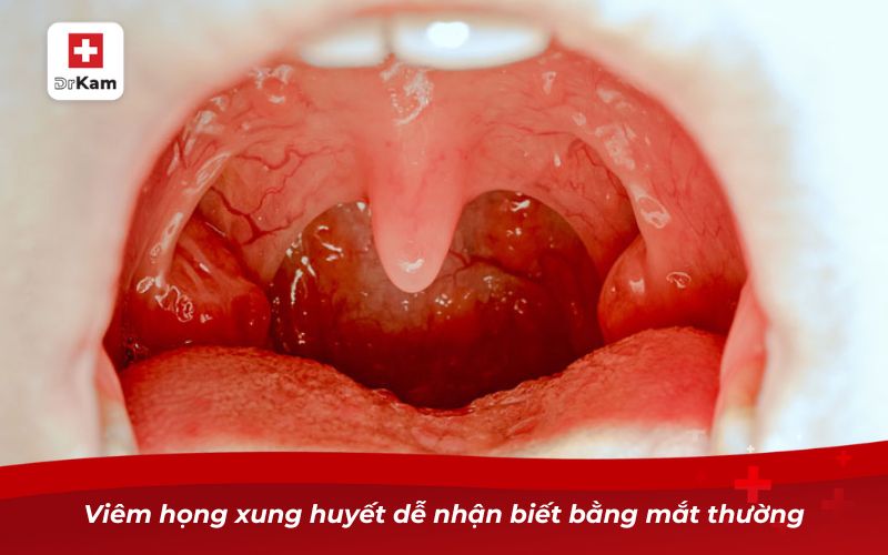 Nhận diện bệnh thông qua hình ảnh viêm họng xung huyết 7 Viêm họng xung huyết dễ nhận biết bằng mắt thường