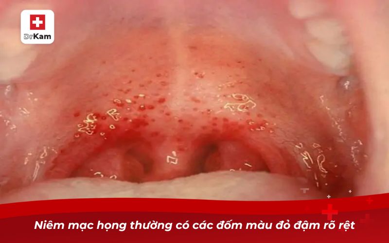 Nhận diện bệnh thông qua hình ảnh viêm họng xung huyết 8 Niêm mạc họng thường có các đốm màu đỏ đậm rõ rệt