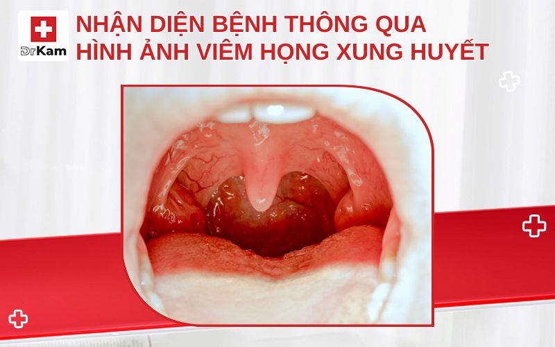 hinh anh viem hong xung huyet thumbnail