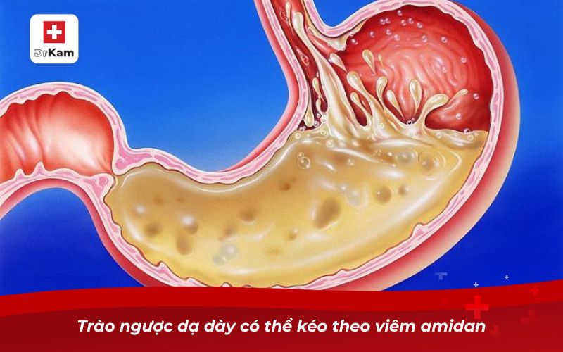 Nguyên nhân viêm amidan và cách phòng tránh hiệu quả 9 Trào ngược dạ dày có thể kéo theo viêm amidan