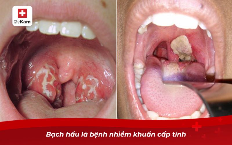 Hướng dẫn phân biệt bạch hầu và viêm họng 8 Bạch hầu là bệnh nhiễm khuẩn cấp tính