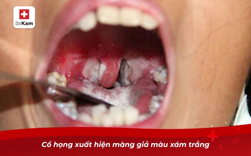 Hướng dẫn phân biệt bạch hầu và viêm họng 9 Cổ họng xuất hiện màng giả màu xám trắng