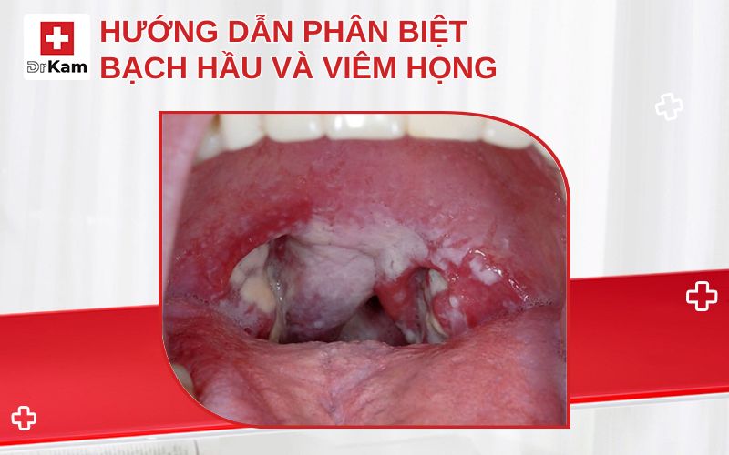phan biet bach hau va viem hong thumbnail