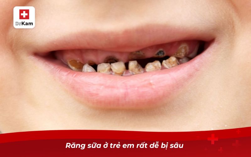 Sâu răng sữa ở trẻ em và những điều cần biết 6 Răng sữa ở trẻ em rất dễ bị sâu