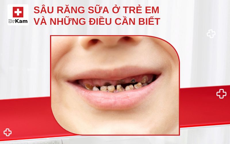 sau rang sua o tre em thumbnail